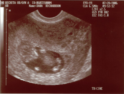 First Sonogram Picture